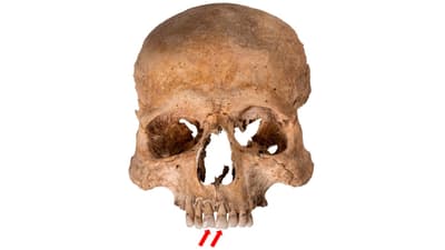 Vorderansicht eines menschlichen Schädels mit Pfeilen auf Zähne gerichtet.